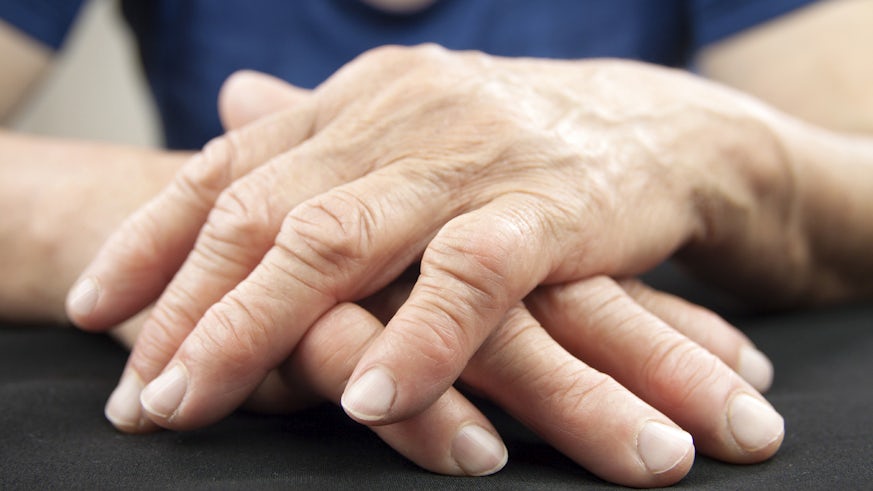 Hands with noticeable arthritus joints 