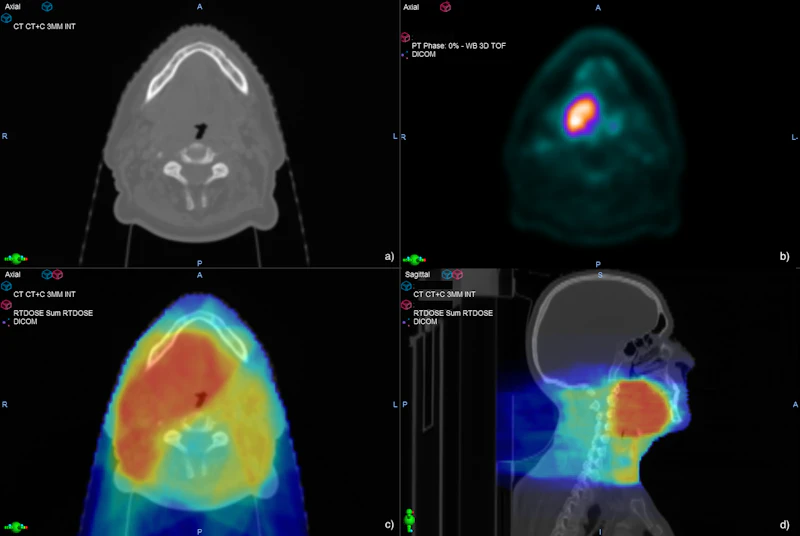 Functional Imaging: Computed Tomography providing anatomical information (a) and Positron Emission Tomography providing functional data (b) are used to calculate optimal dose distribution shown in the axial (c) and sagittal plane (d). 