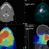 Functional Imaging: Computed Tomography providing anatomical information (a) and Positron Emission Tomography providing functional data (b) are used to calculate optimal dose distribution shown in the axial (c) and sagittal plane (d). 