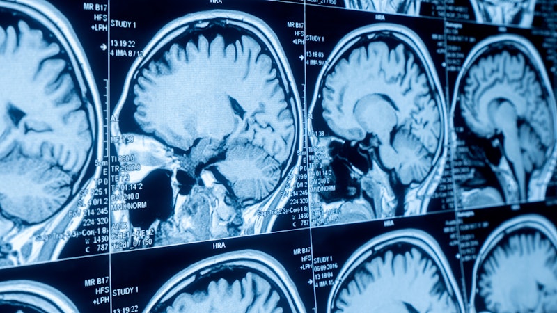 Team of Cardiff researchers aim to make significant strides in the fight against Glioblastoma 