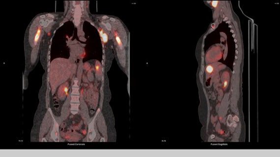 A PET scan test result showing coronal and sagittal plane views