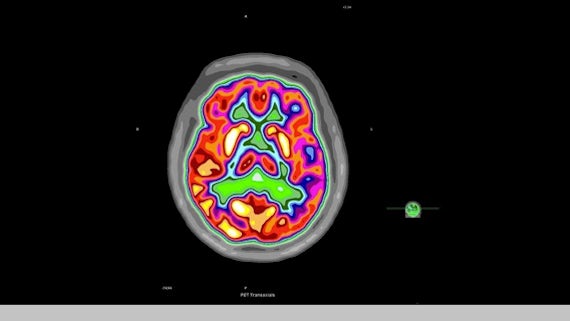A PET scan result for a patient with epilepsy.