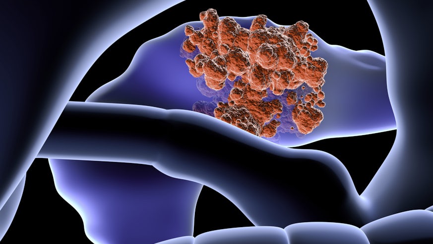 Artist's impression of pancreatic cancer