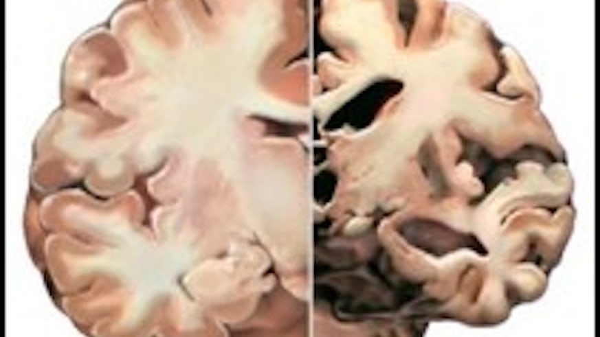 Healthy Brain v's Brain affected by Alzheimer's