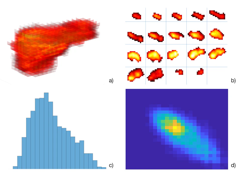 Image Analysis: Three-dimensional rendering of oesophageal cancer imaged with Positron Emission Tomography (a) slice by slice image representation of the gross tumour volume (b) histogram distribution of the voxel data (c) and texture analysis with grey level co-occurrence matrix calculation (d).   