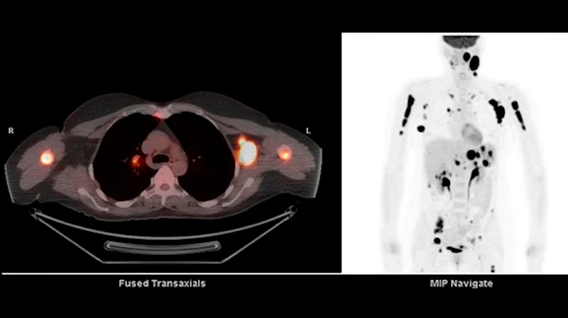 PET scan test results for lymph.