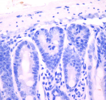 Understanding the links between diet and cancer
