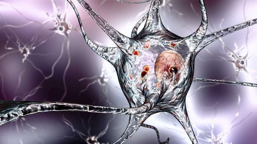 Parkinson's disease 3D illustration showing neurons containing Lewy bodies 