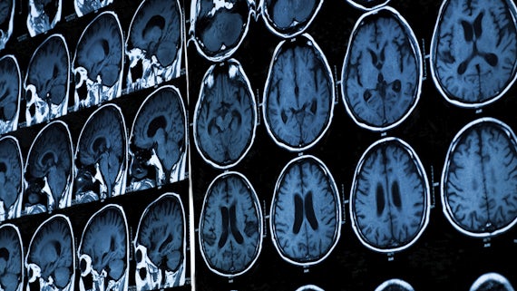 Brain images MRI scan
