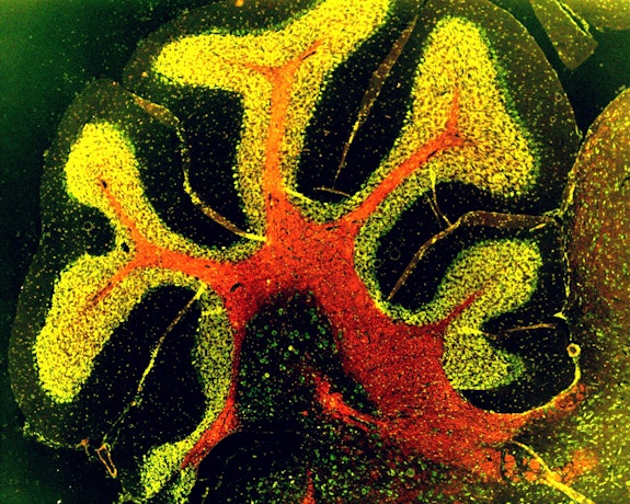 Chronic Inflammation