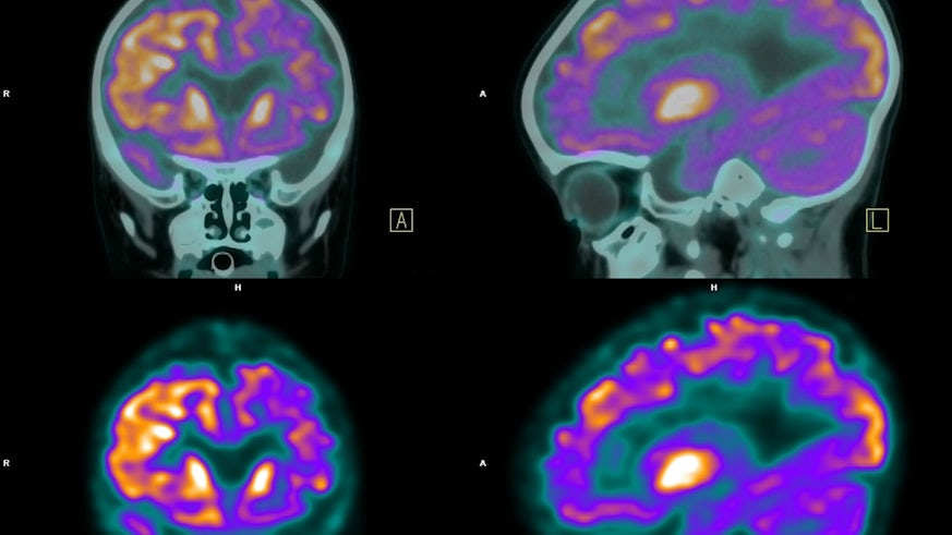 PET scan image of the brain