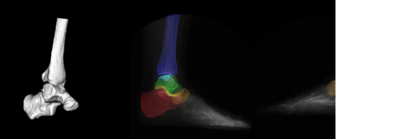 A computer model of an ankle is set against a black background. The ankle is shown in the colours white, yellow, green, blue and red.