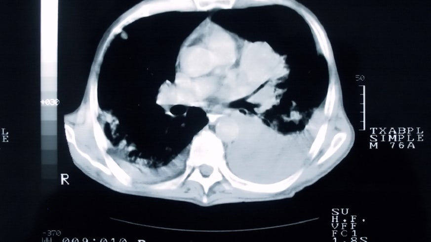 CT scan of cancerous lungs
