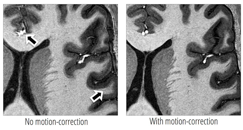 Medical Imaging: A zoomed section of a full volume acquired at 0.33 x 0.33 x 1.00 mm, showing the improvements following retrospective motion-correction using 3D FatNavs algorithm.