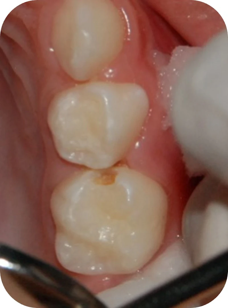 Caries lesion in a primary tooth.