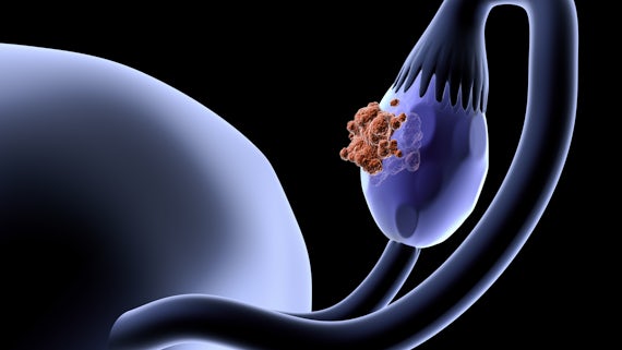 Ovary Cancer