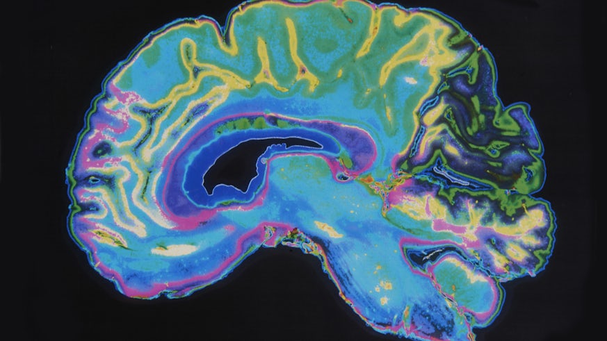 Colourful MRI scan of a brain