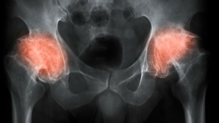 Image of inflamed hip joints on x-ray