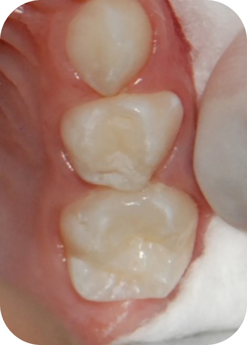 Clinical appearance after restorative treatment of caries lesion.