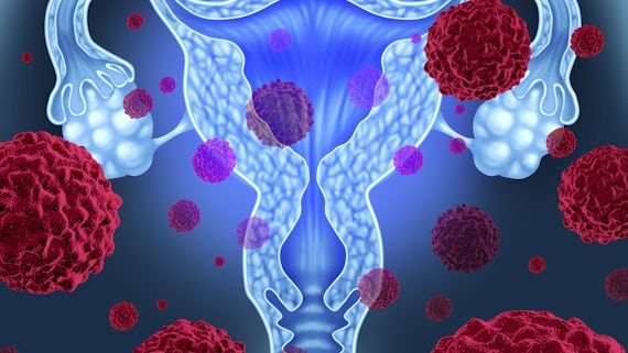Ovarian Cancer 