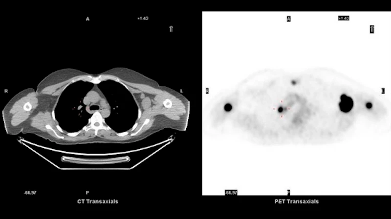 PET scan test results for lymph.