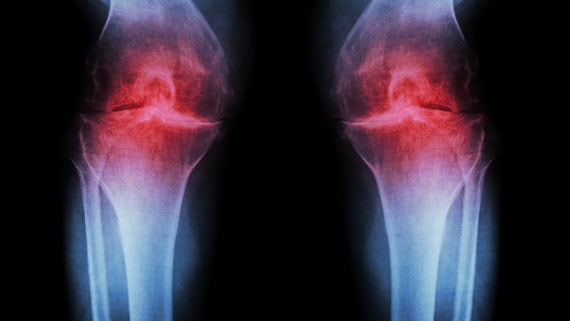 Image of a medical scan of arthritic knees