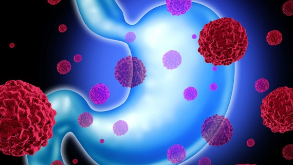 Gastric cancer